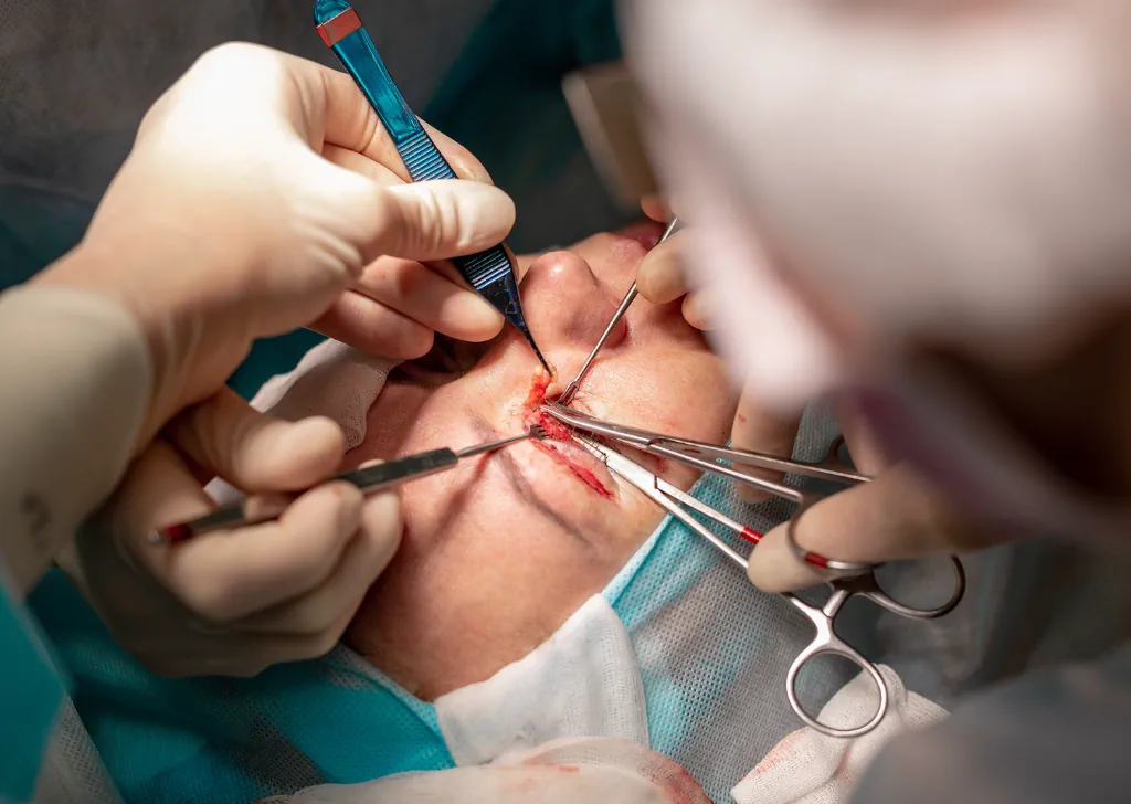 What can you expect from a Blepharoplasty operation?